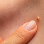 Papilloma on human skin