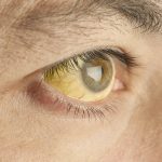 Ojos de color amarillo es uno de los principales síntomas de la enfermedad